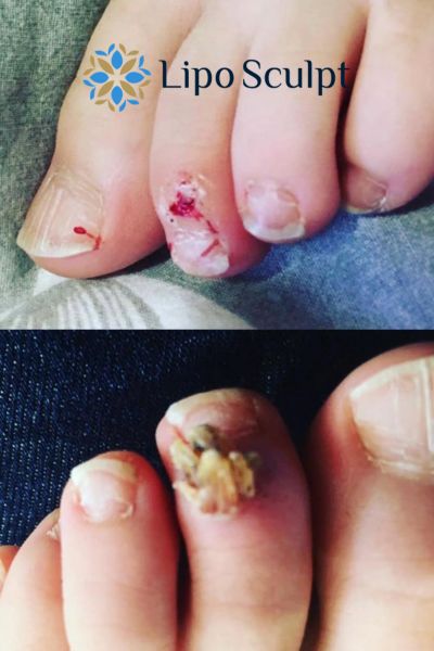 Wart removal customer results from Lipo Sculpt Lowestoft
